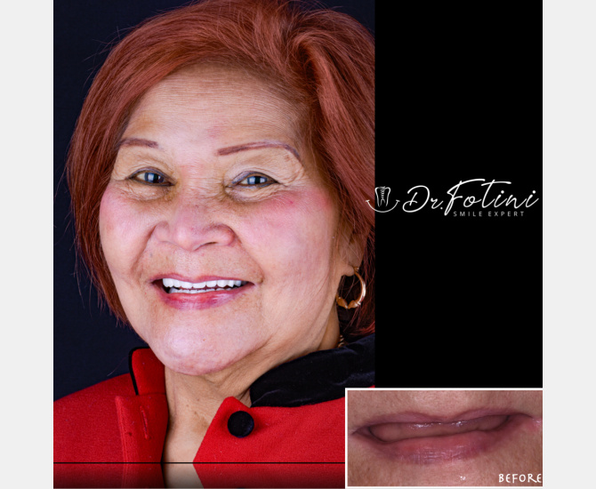 Smile Transformation Before and After by Dr. Fotini in Tysons Corner, VA