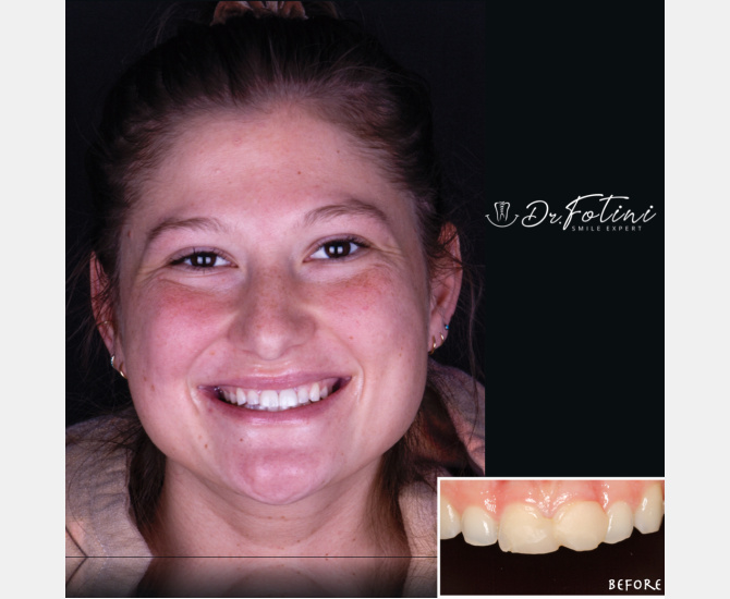 Smile Transformation Before and After by Dr. Fotini in Tysons Corner, VA