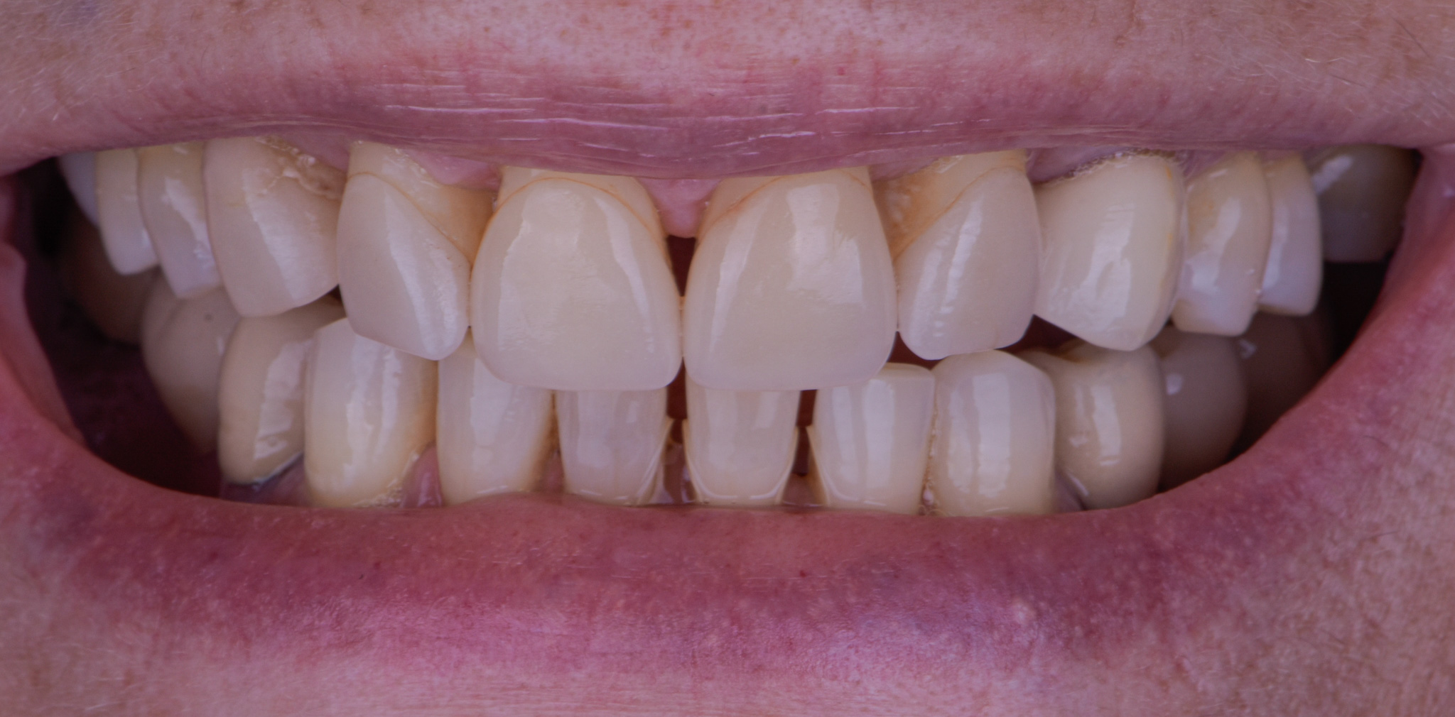 Full Mouth Reconstruction On Teeth - Before