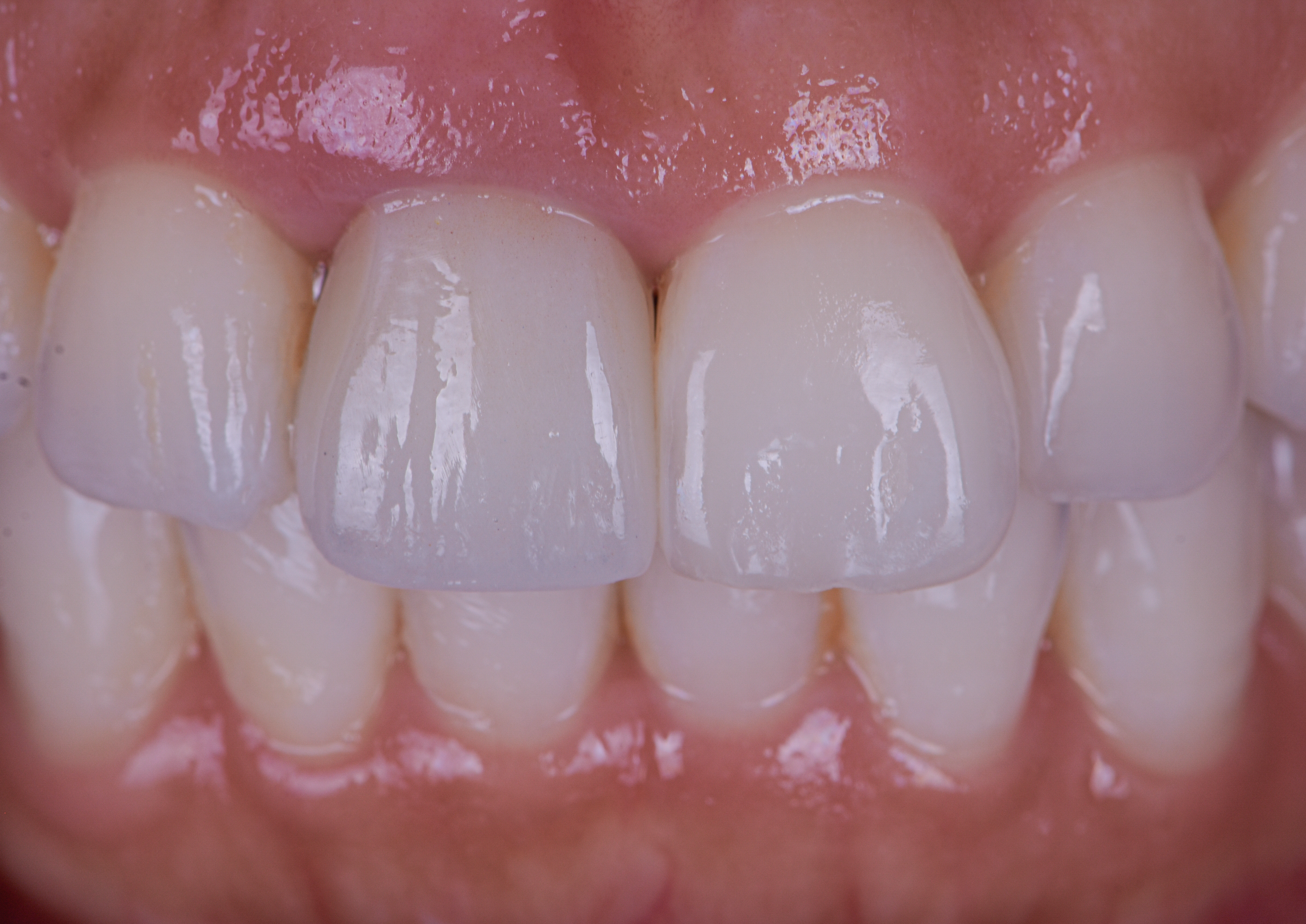 Implant Crown To Replace Central Incisor - After