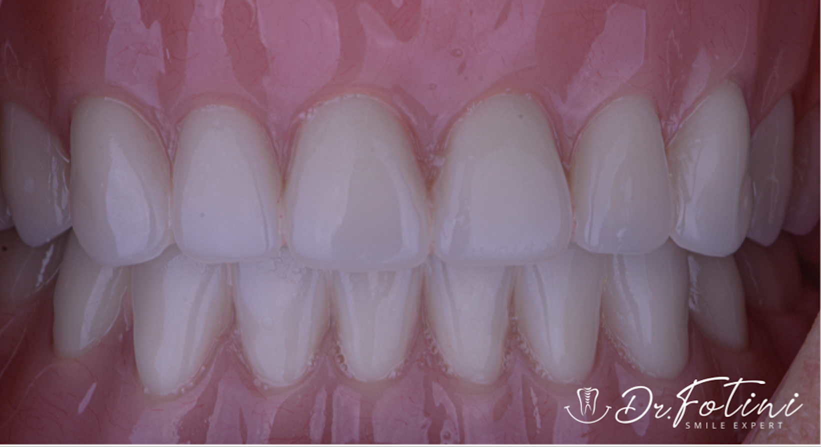 Implant Supported Overdentures Removable - After