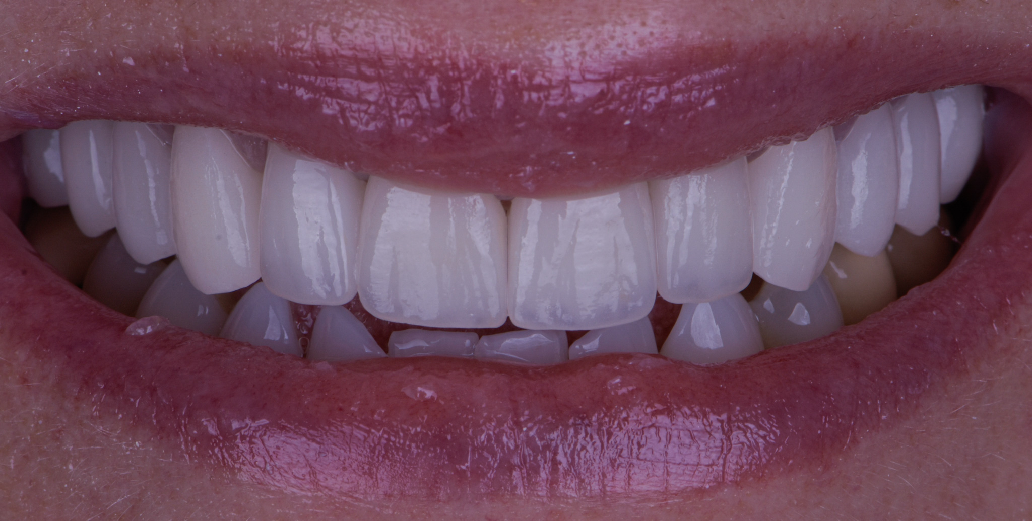 Smile Makeover With Porcelain Crowns - After