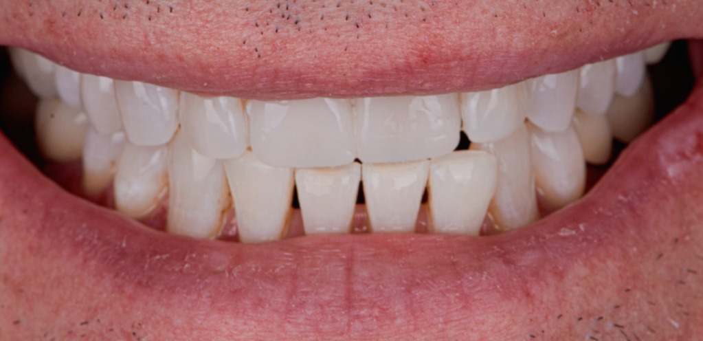 Teeth Whitening Porcelain Veneer Crown Cosmetic Bonding - After