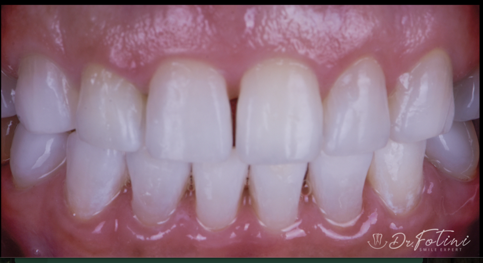 Teeth Whitening - After
